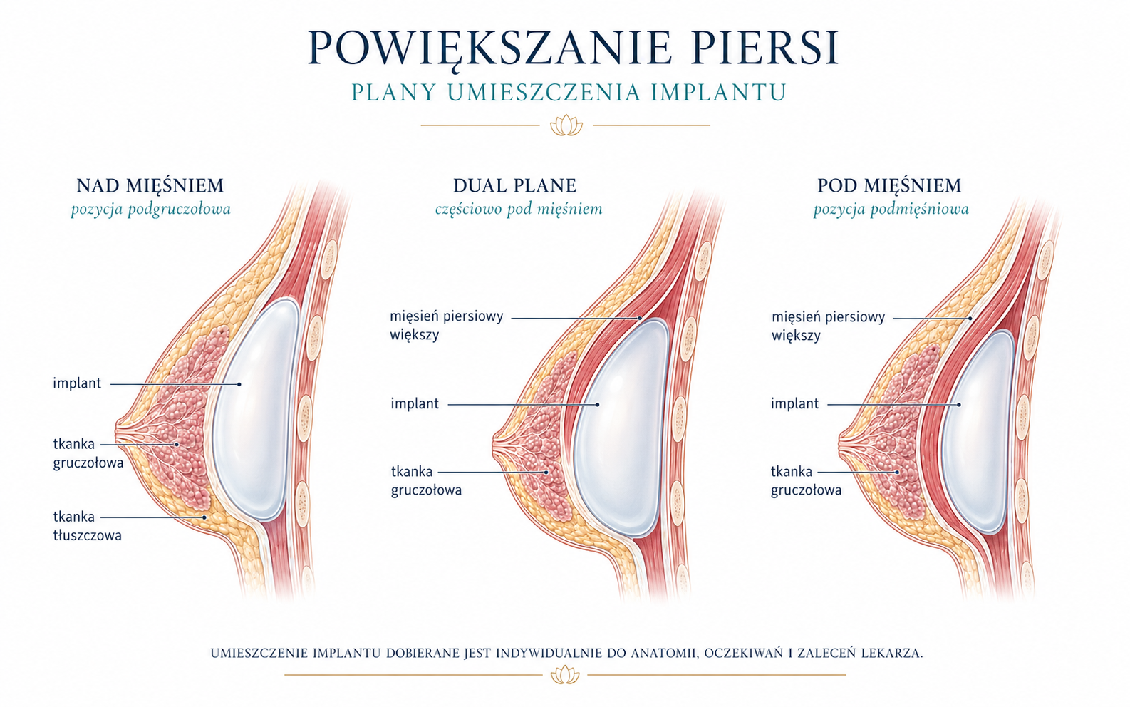 Płaszczyzny implantów